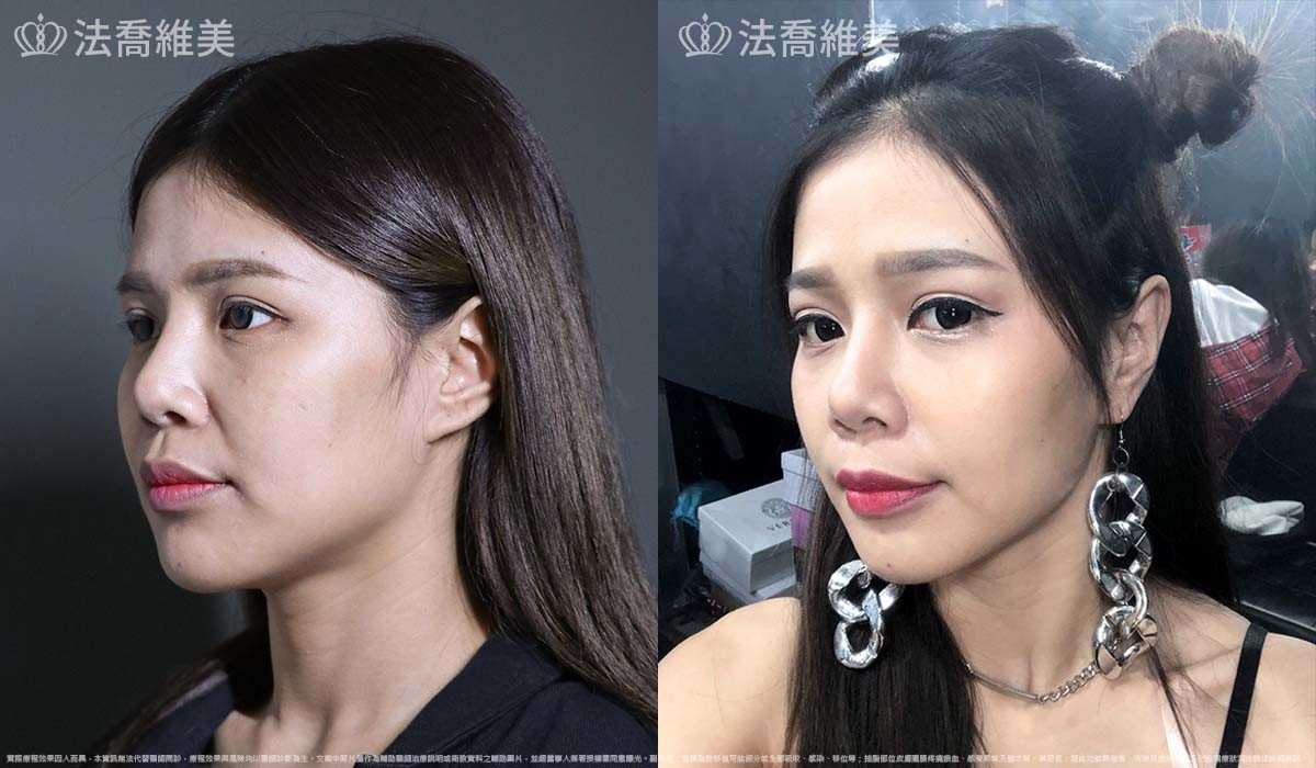 異體真皮鼻唇溝法令填補術,法令紋