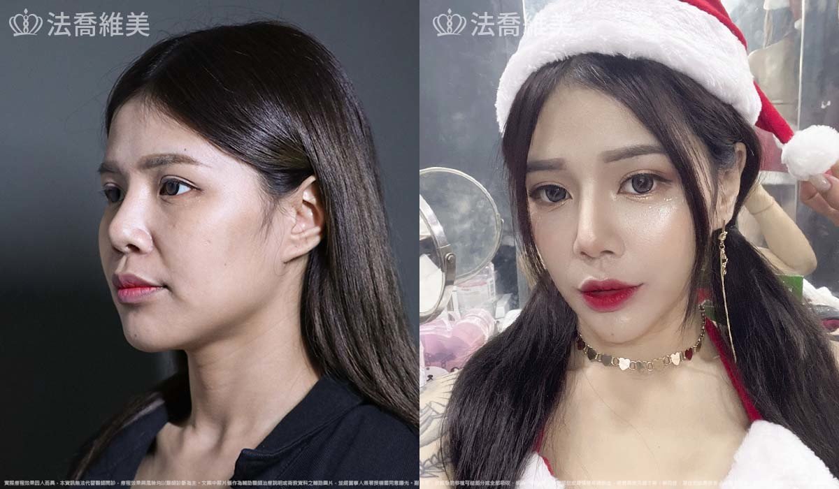 異體真皮鼻唇溝法令填補術,法令紋