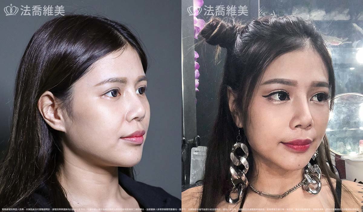 異體真皮鼻唇溝法令填補術,法令紋