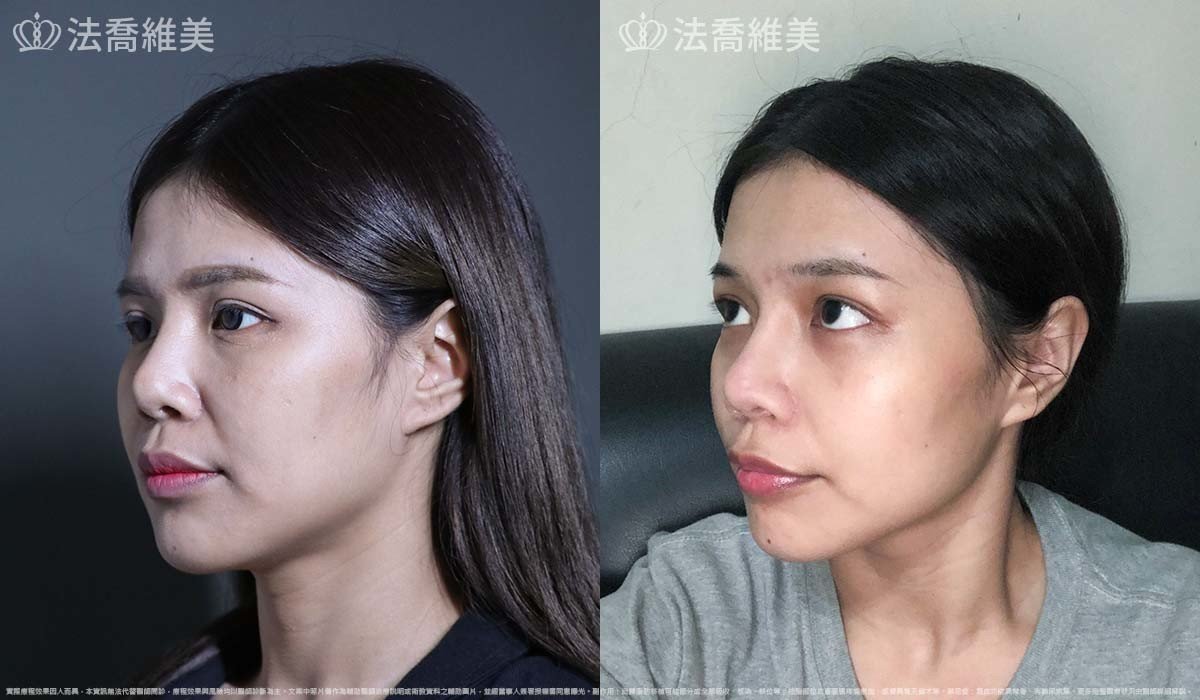 異體真皮鼻唇溝法令填補術,法令紋