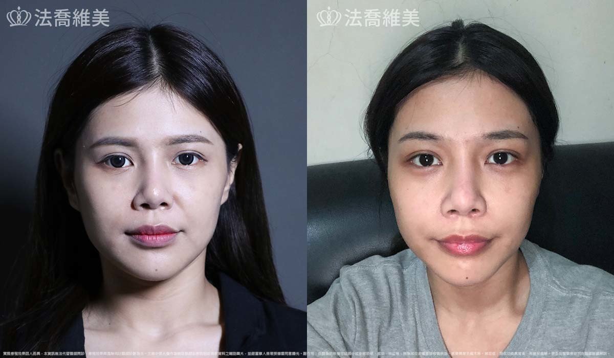 異體真皮鼻唇溝法令填補術,法令紋