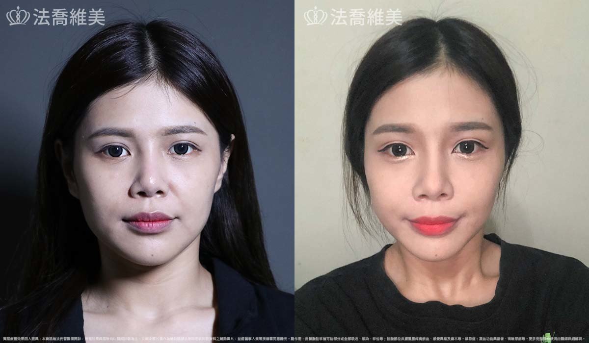 異體真皮鼻唇溝法令填補術,法令紋