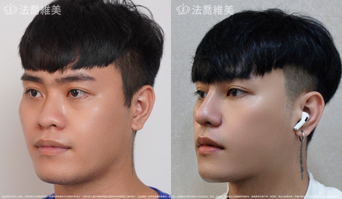 Goretex隆鼻,縮鼻翼