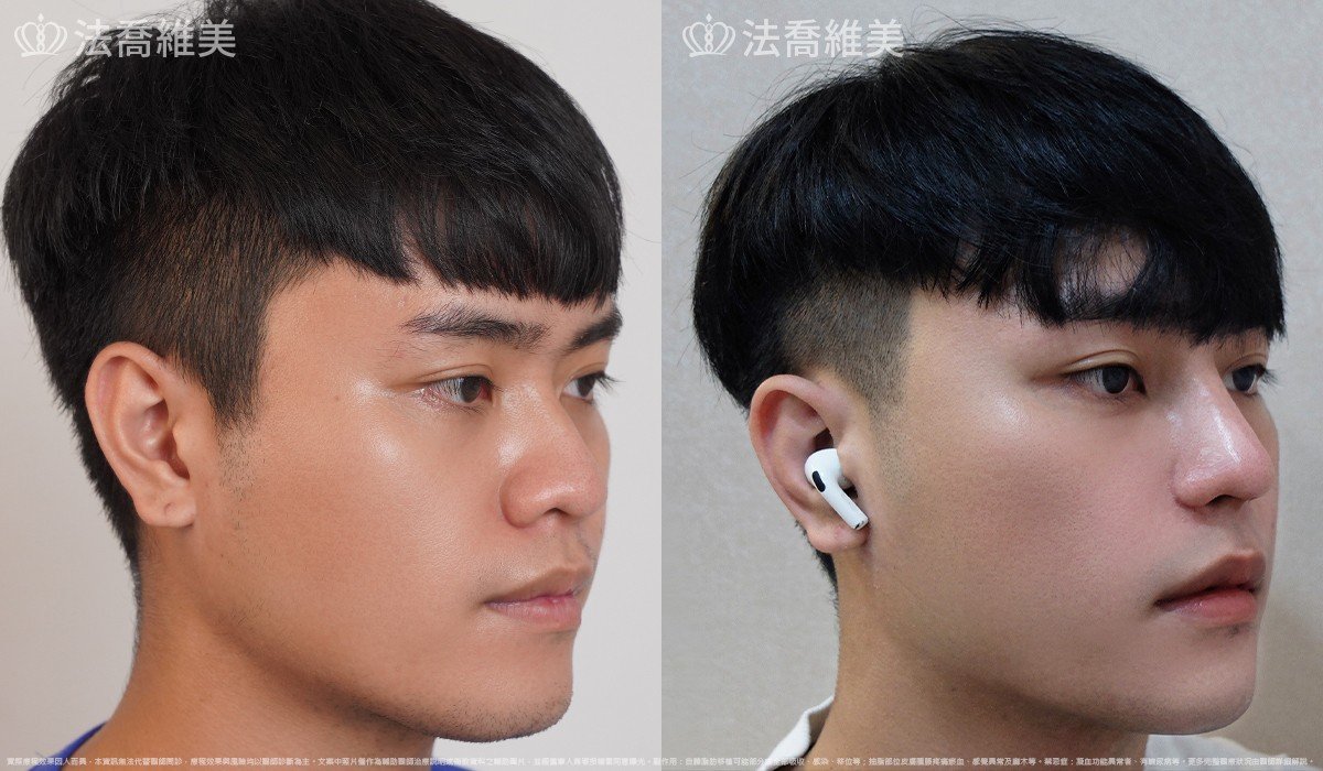Goretex隆鼻,縮鼻翼