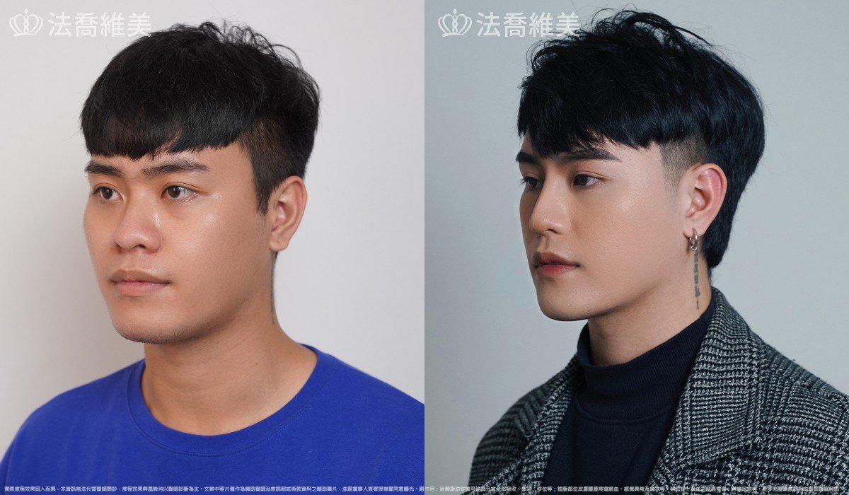 Goretex隆鼻,縮鼻翼