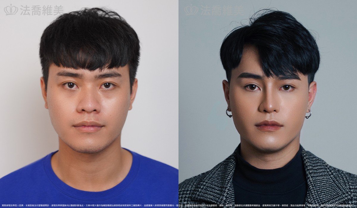 Goretex隆鼻,縮鼻翼