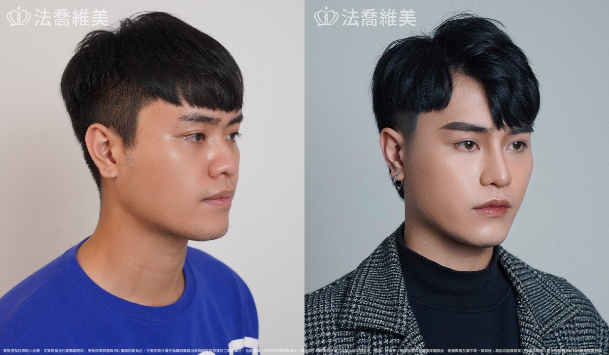 Goretex隆鼻,縮鼻翼
