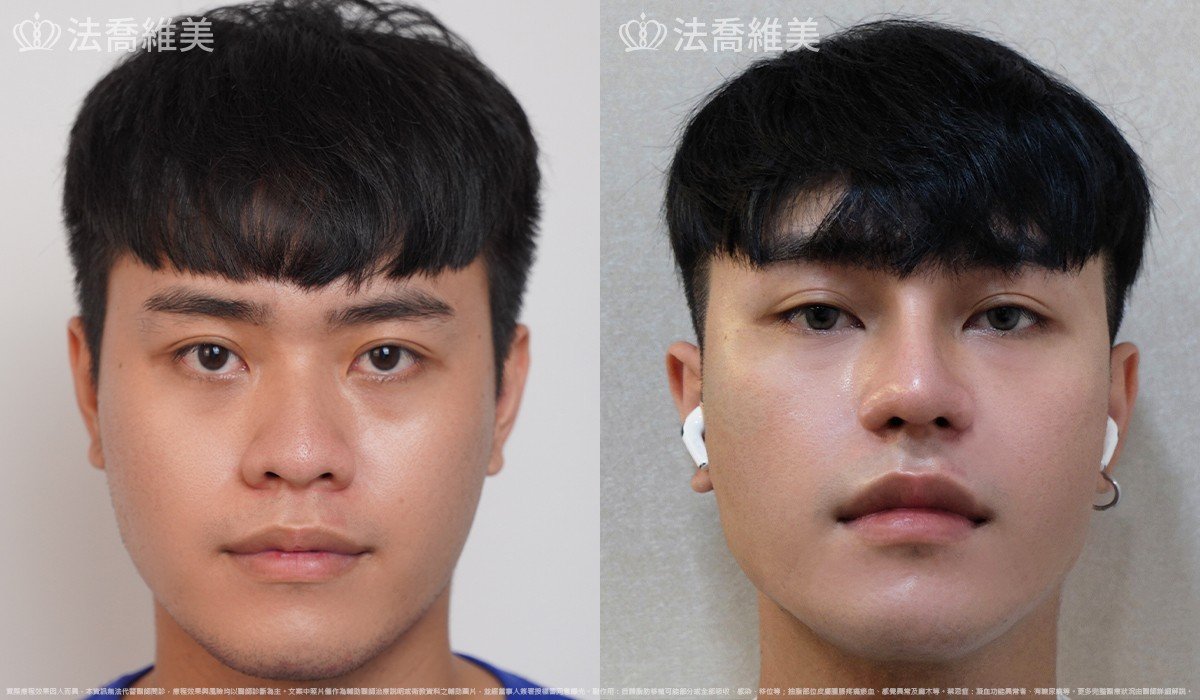 Goretex隆鼻,縮鼻翼