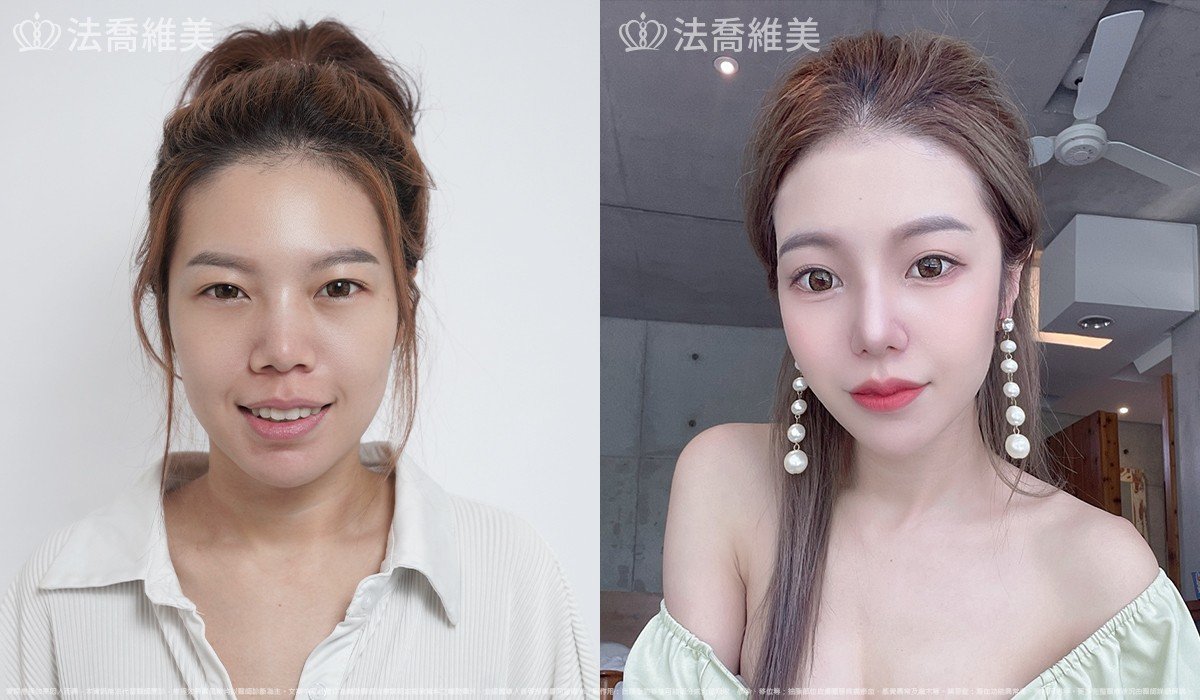 Goretex隆鼻,縮鼻翼
