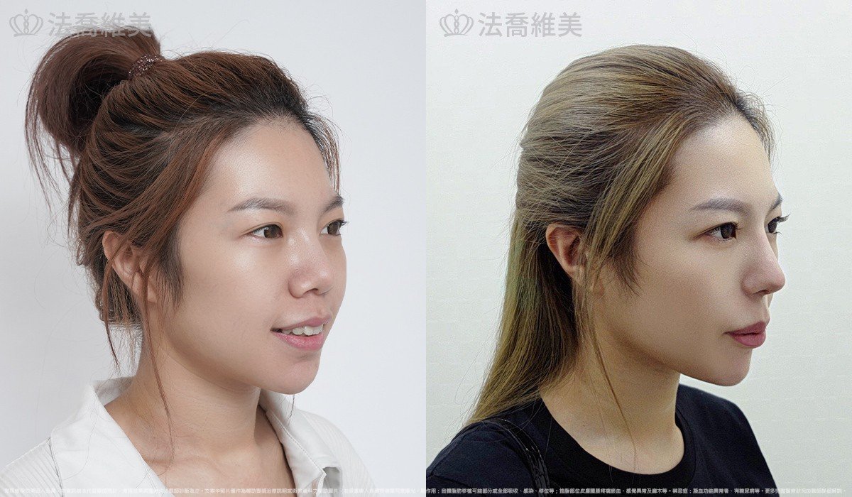 Goretex隆鼻,縮鼻翼