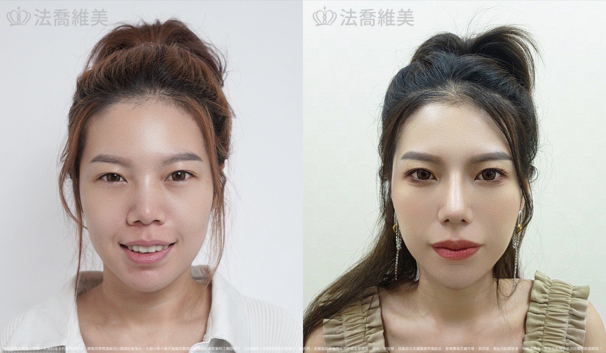 Goretex隆鼻,縮鼻翼