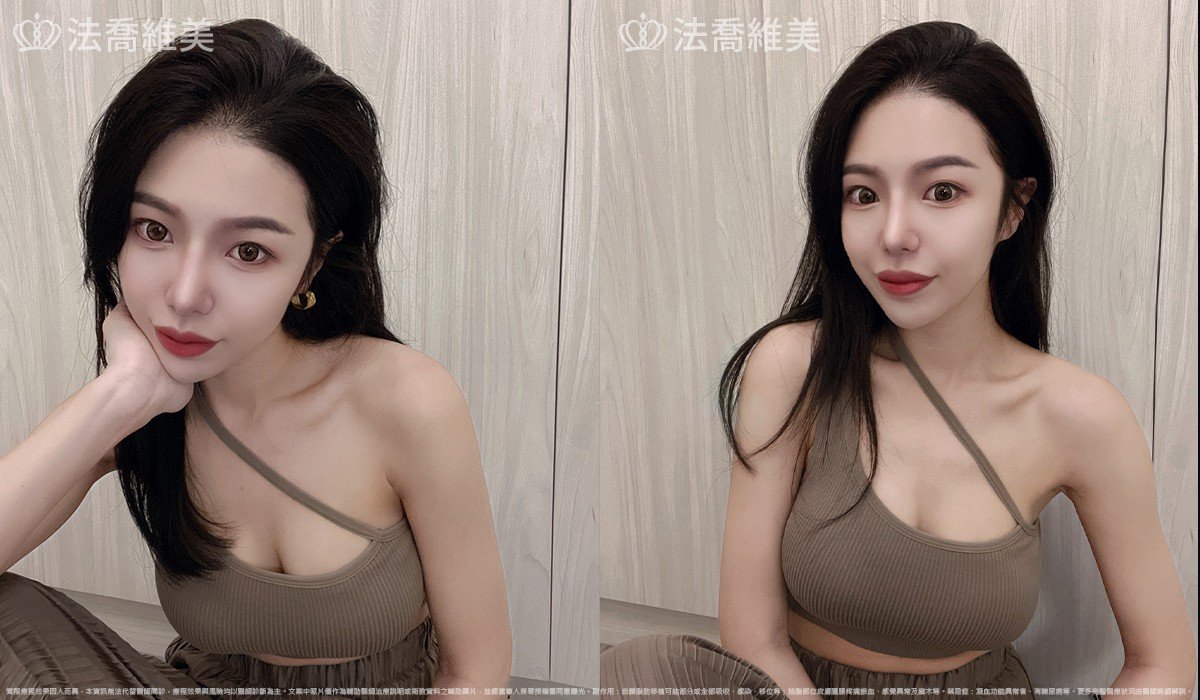 Goretex隆鼻,縮鼻翼