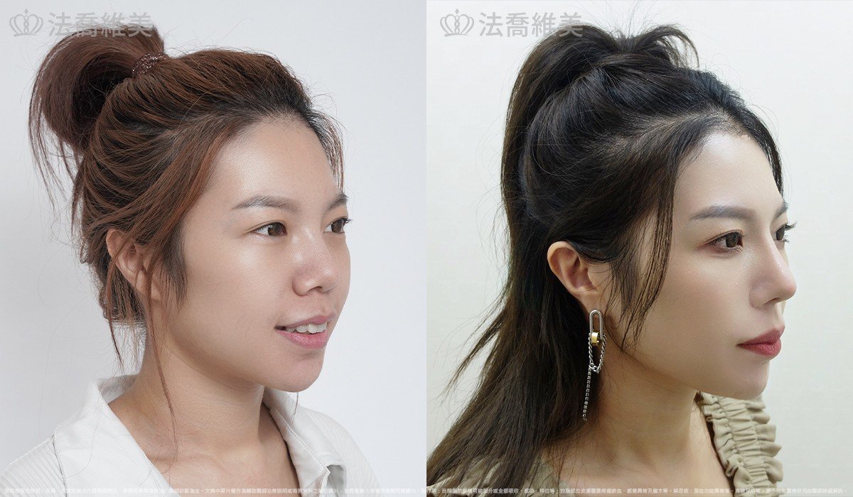 Goretex隆鼻,縮鼻翼