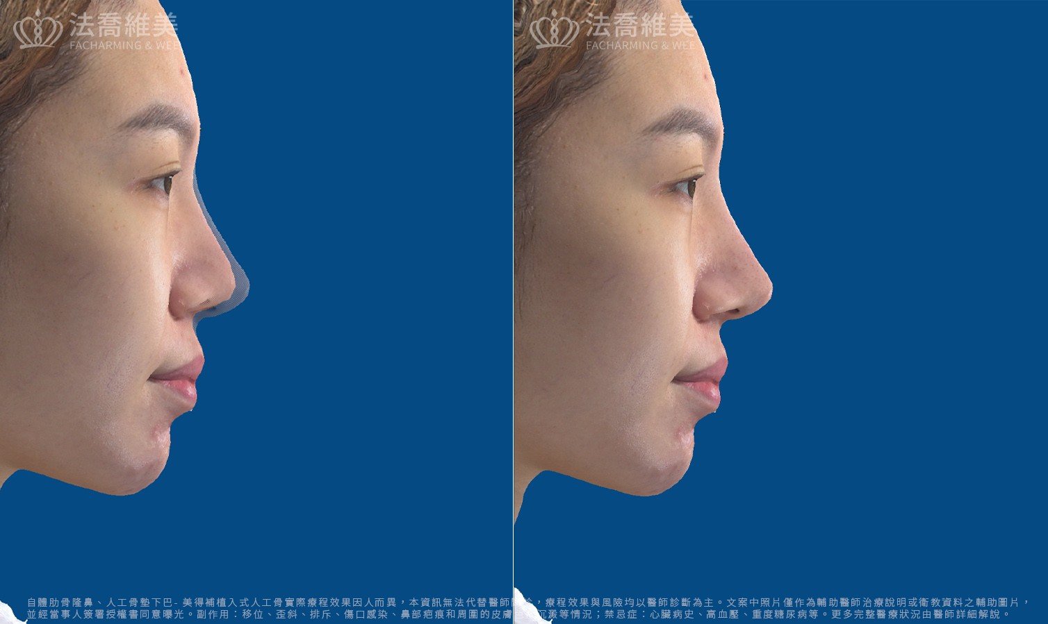 Goretex隆鼻,縮鼻翼,3D影像模擬圖